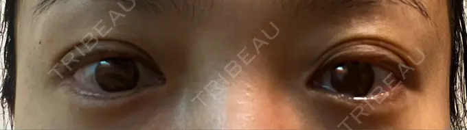 その他（目元） みずほクリニック DAY 9 メイン用