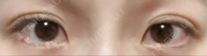 二重埋没 グローバルビューティークリニック 東京院 AFTER メイン用