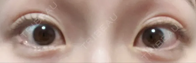 二重埋没 グローバルビューティークリニック 東京院 DAY 7 メイン用