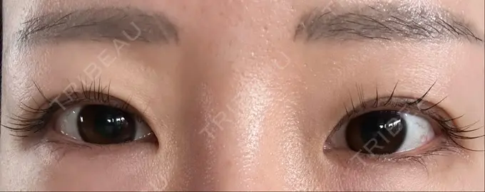 ボトックス（タレ目） ルラ美容クリニック 渋谷本院 DAY 5 メイン用