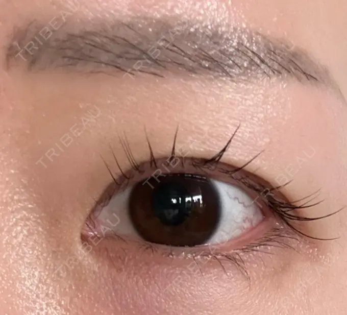 ボトックス（タレ目） ルラ美容クリニック 渋谷本院 DAY 5 メイン用