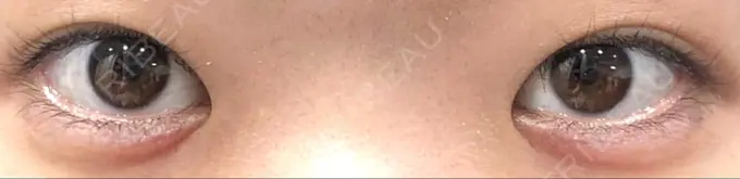 ヒアルロン酸注入（涙袋） しのぶ皮膚科 AFTER メイン用