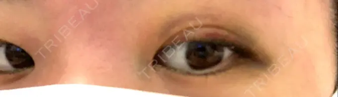 二重埋没 湘南美容クリニック 二子玉川院 DAY 4 メイン用