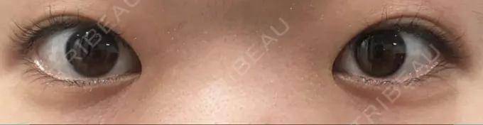 二重埋没 湘南美容クリニック 二子玉川院 AFTER メイン用