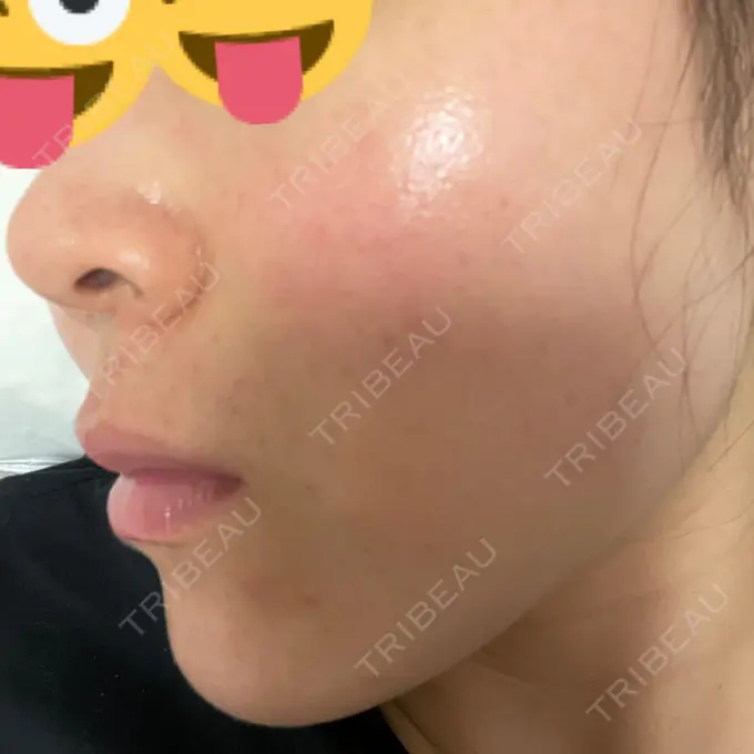 ピコレーザートーニング（美白・肝斑） アモーレクリニック 名古屋院 DAY 6 メイン用