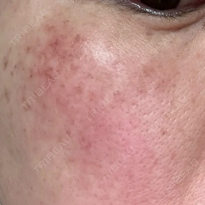 イオン導入 / 光治療（フォトフェイシャルなど） メディアージュクリニック 青山院 DAY 1 メイン用