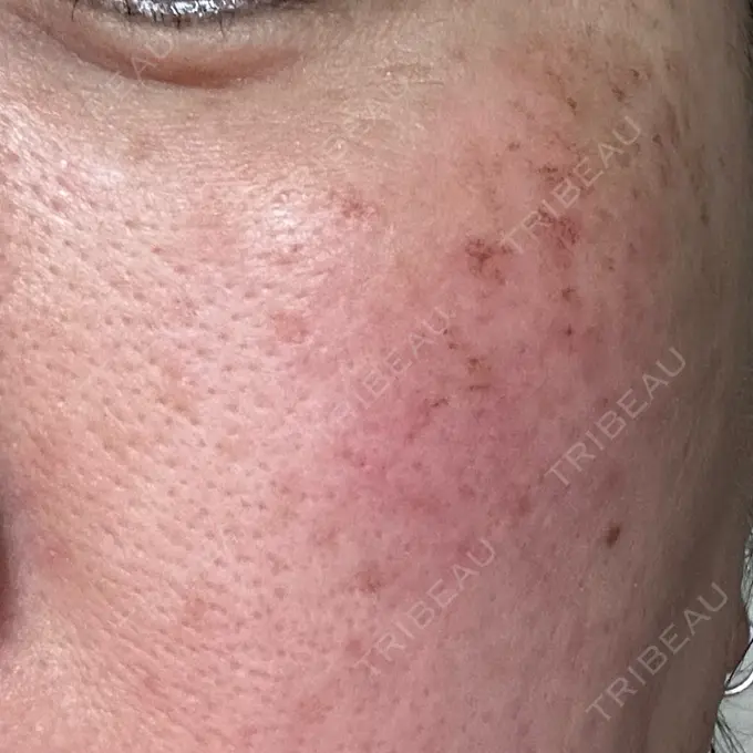 イオン導入 / 光治療（フォトフェイシャルなど） メディアージュクリニック 青山院 DAY 1 メイン用