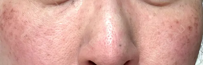 イオン導入 / 光治療（フォトフェイシャルなど） メディアージュクリニック 青山院 DAY 1 メイン用