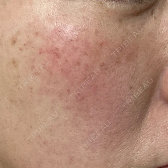 イオン導入 / 光治療（フォトフェイシャルなど） メディアージュクリニック 青山院 DAY 0 メイン用