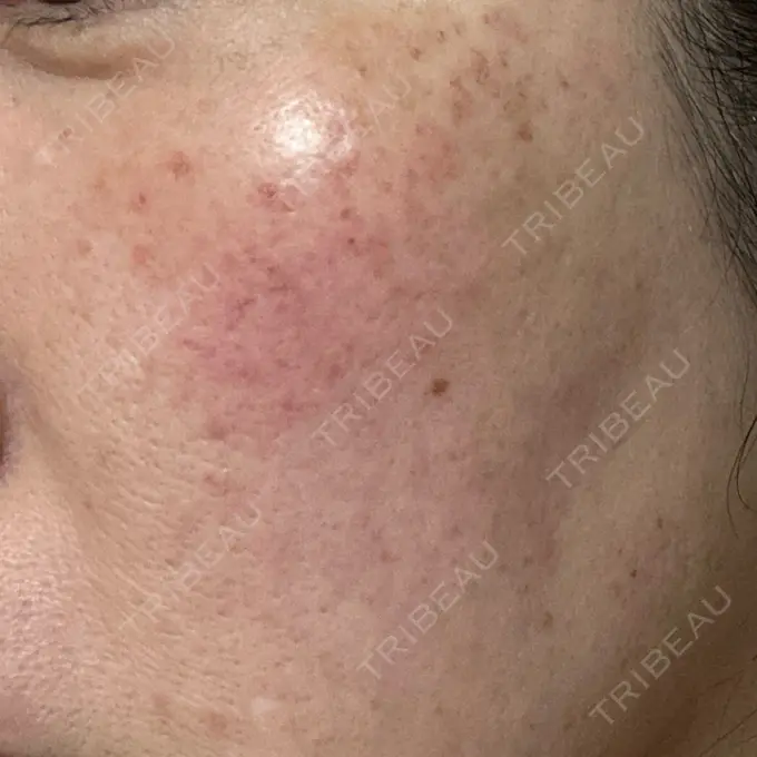 イオン導入 / 光治療（フォトフェイシャルなど） メディアージュクリニック 青山院 DAY 0 メイン用