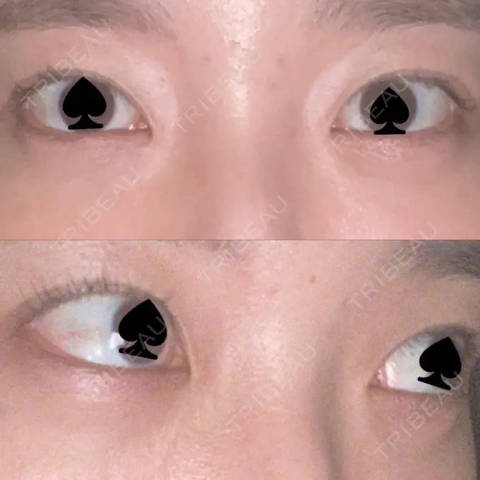 下まぶたたるみ取り / 下まぶたの脂肪取り / その他（目元） 吉井クリニック DAY 14 メイン用