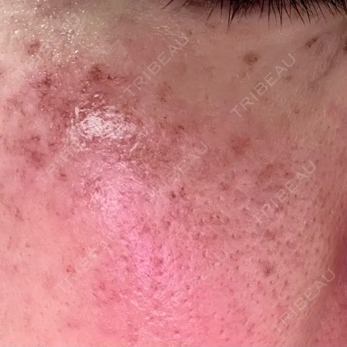 イオン導入 / 光治療（フォトフェイシャルなど） メディアージュクリニック 青山院 AFTER メイン用