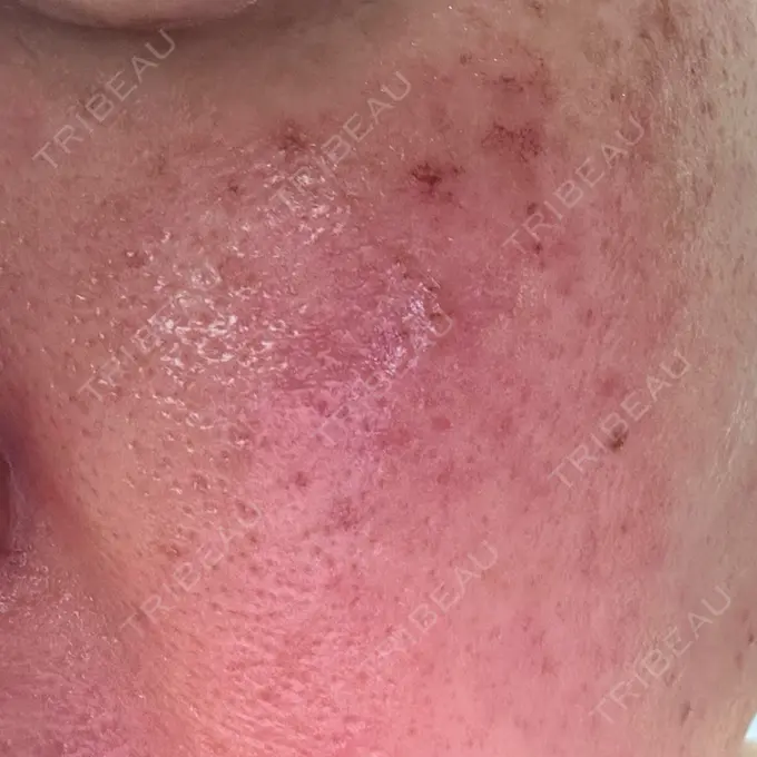 イオン導入 / 光治療（フォトフェイシャルなど） メディアージュクリニック 青山院 DAY 2 メイン用