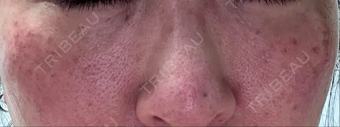 イオン導入 / 光治療（フォトフェイシャルなど） メディアージュクリニック 青山院 DAY 2 メイン用