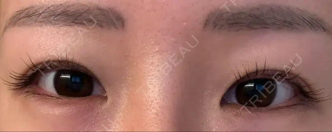 ボトックス（タレ目） ルラ美容クリニック 渋谷本院 DAY 7 メイン用