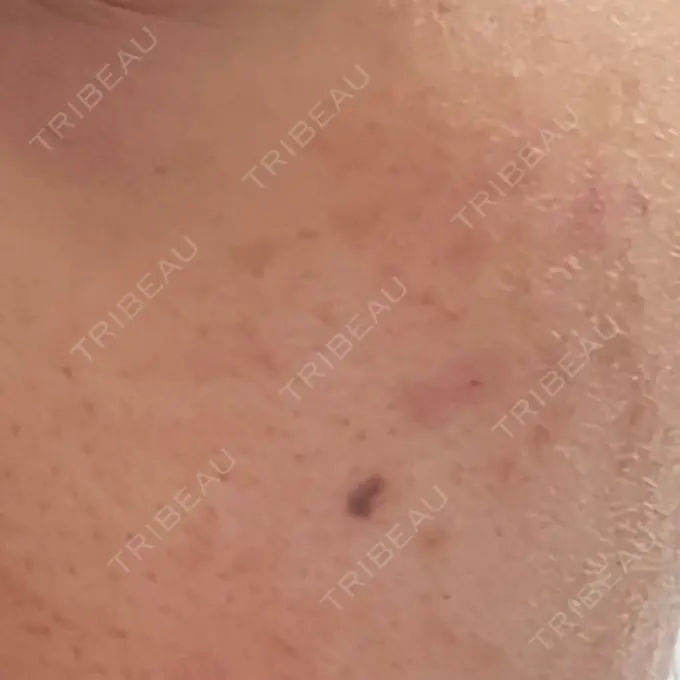 ピコスポット LOUIS CLINIC 二子玉川院【ルイクリニック】 DAY 8 メイン用