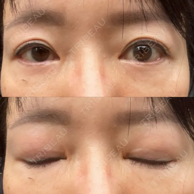二重切開 / 眼瞼下垂（切開） / 下まぶたたるみ取り / 眉下切開 e:Top clinic（イートップクリニック） AFTER メイン用