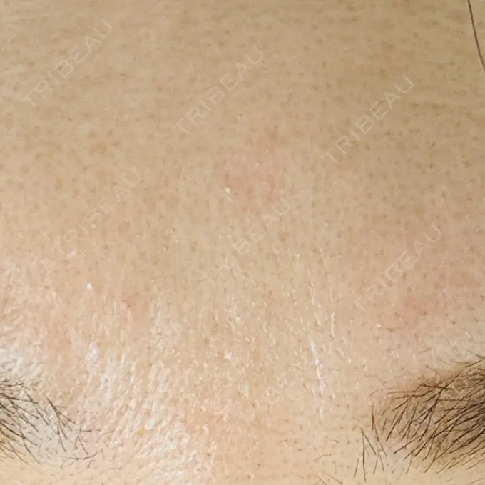 美容点滴・美容注射（美肌） 品川スキンクリニック広島院 DAY 8 メイン用