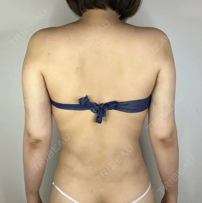 脂肪吸引（二の腕） GAYA body design clinic AFTER メイン用