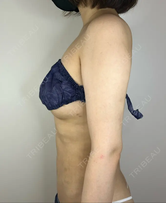 脂肪吸引（二の腕） GAYA body design clinic DAY 91 メイン用