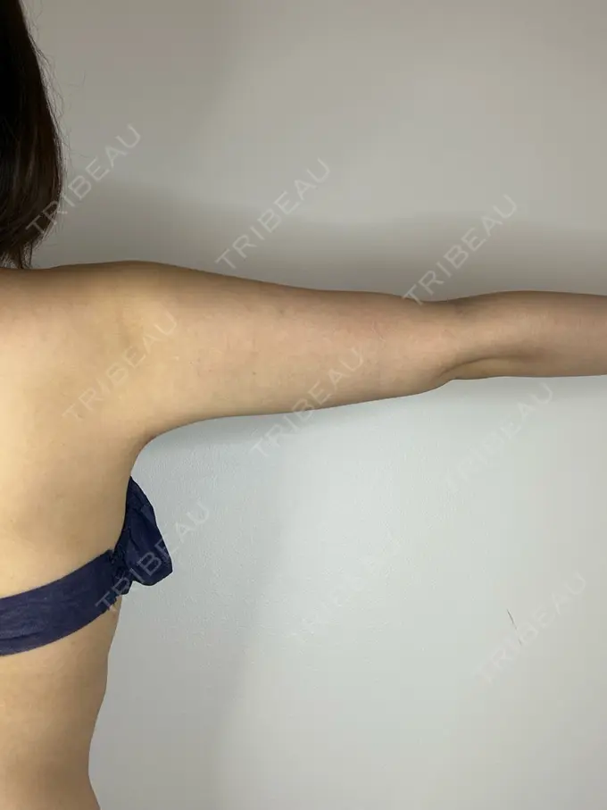 脂肪吸引（二の腕） GAYA body design clinic DAY 91 メイン用