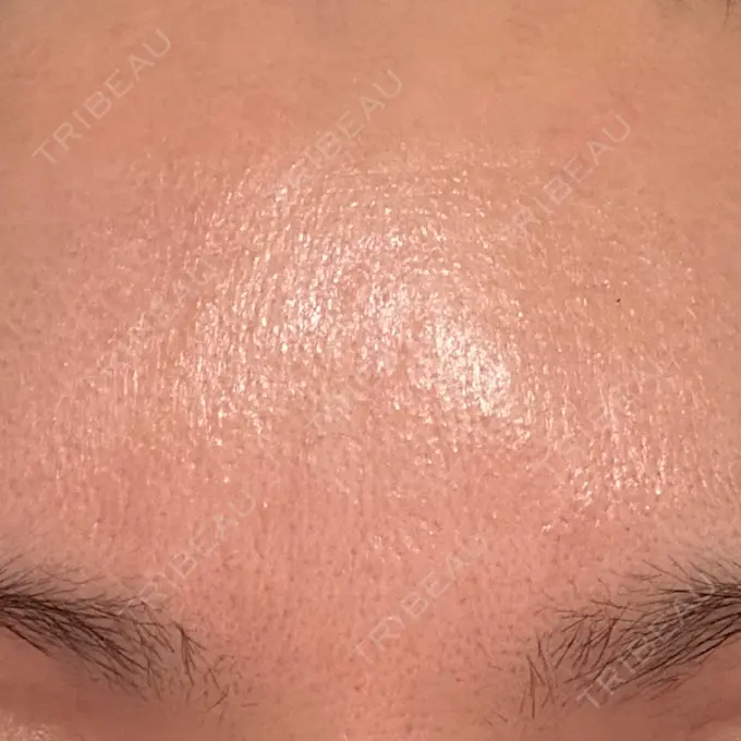 美容点滴・美容注射（美肌） 品川スキンクリニック広島院 DAY 9 メイン用