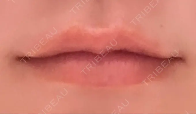 ボトックス（口角） Mavie Beauty Clinic （マヴィービューティークリニック） AFTER メイン用