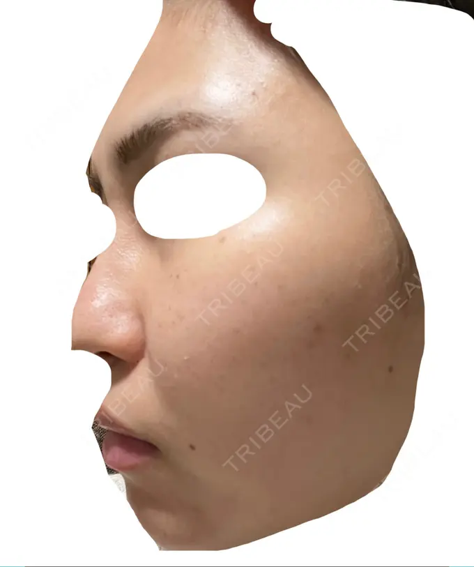 エレクトロポレーション / 毛穴洗浄（ハイドラフェイシャルなど） / 光治療（フォトフェイシャルなど） X CLINIC 大阪院 DAY 0 メイン用