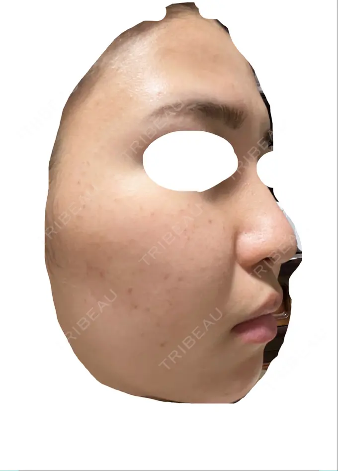 エレクトロポレーション / 毛穴洗浄（ハイドラフェイシャルなど） / 光治療（フォトフェイシャルなど） X CLINIC 大阪院 DAY 0 メイン用