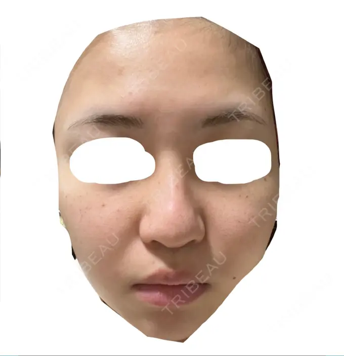 エレクトロポレーション / 毛穴洗浄（ハイドラフェイシャルなど） / 光治療（フォトフェイシャルなど） X CLINIC 大阪院 DAY 1 メイン用