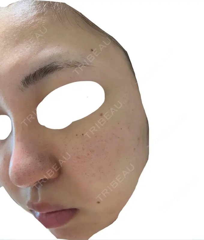 エレクトロポレーション / 毛穴洗浄（ハイドラフェイシャルなど） / 光治療（フォトフェイシャルなど） X CLINIC 大阪院 DAY 1 メイン用