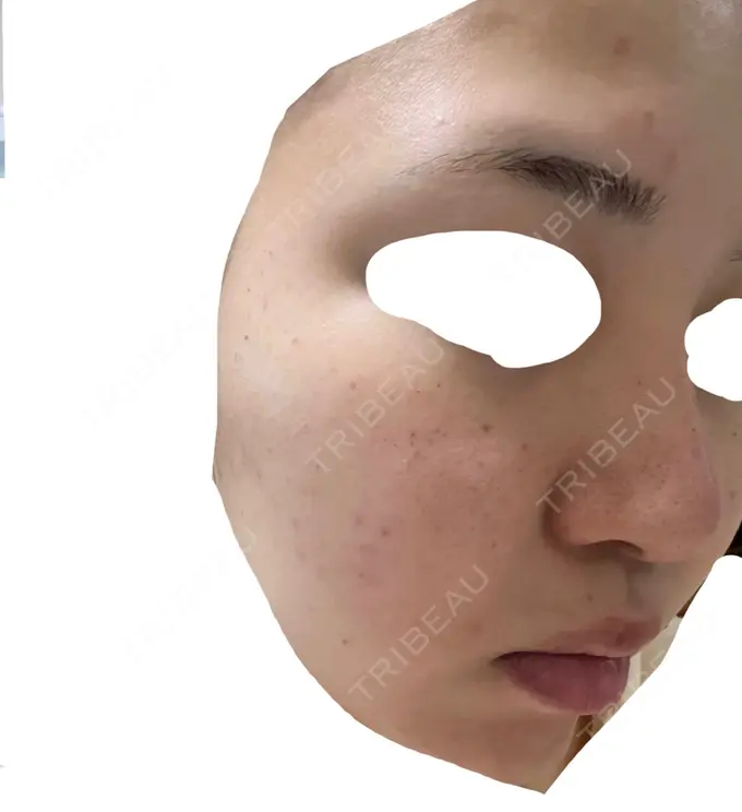 エレクトロポレーション / 毛穴洗浄（ハイドラフェイシャルなど） / 光治療（フォトフェイシャルなど） X CLINIC 大阪院 DAY 1 メイン用