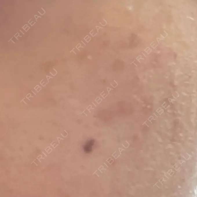 ピコスポット LOUIS CLINIC 二子玉川院【ルイクリニック】 DAY 9 メイン用