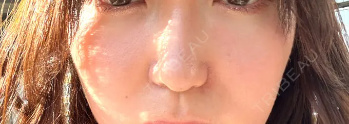 小鼻縮小（切開） / 鼻翼挙上 東京美容医療クリニック 池袋院 DAY 21 メイン用