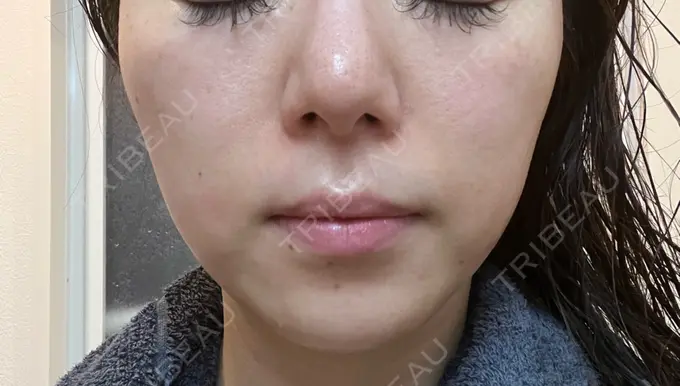 エレクトロポレーション 若倉診療所 AFTER メイン用