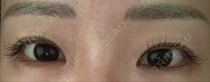 ボトックス（タレ目） ルラ美容クリニック 渋谷本院 AFTER メイン用