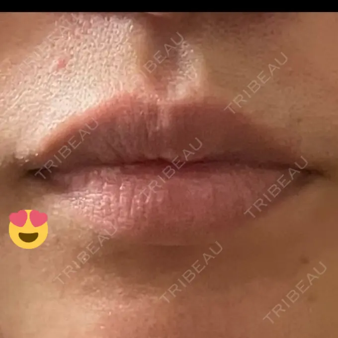 口角挙上 宇都宮竹内クリニック DAY 87 メイン用