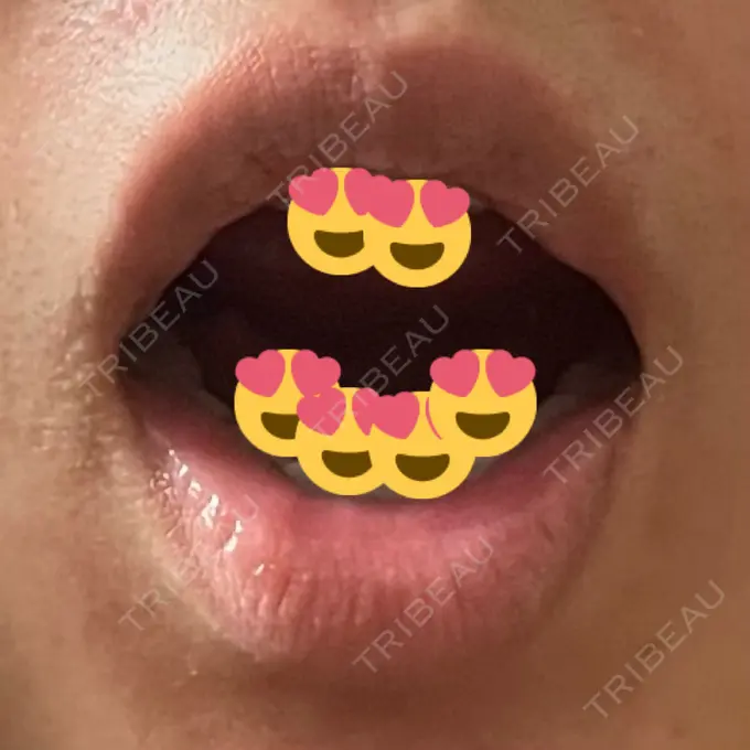 口角挙上 宇都宮竹内クリニック DAY 87 メイン用