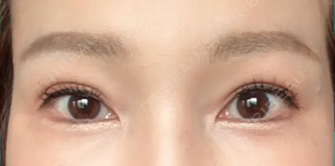 二重埋没 / 目元修正 オーキッド美容クリニック東京御徒町 DAY 33 メイン用