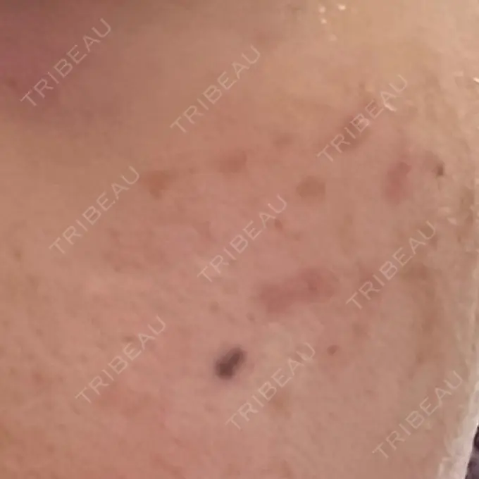 ピコスポット LOUIS CLINIC 二子玉川院【ルイクリニック】 DAY 10 メイン用