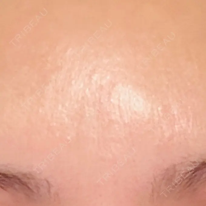 美容点滴・美容注射（美肌） 品川スキンクリニック広島院 AFTER メイン用