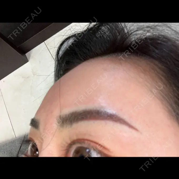 ヒアルロン酸注入（額） 吉井クリニック DAY 53 メイン用