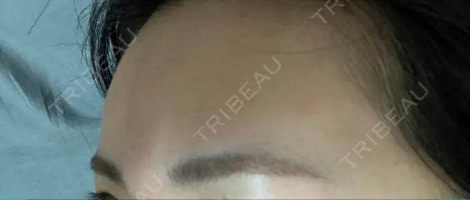 ヒアルロン酸注入（額） 吉井クリニック AFTER メイン用