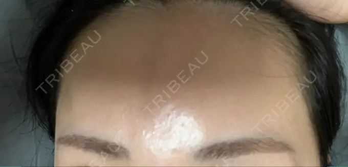 ヒアルロン酸注入（額） 吉井クリニック DAY 120 メイン用