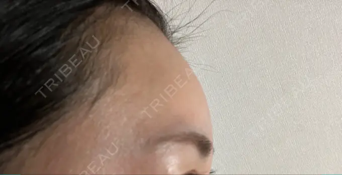 ヒアルロン酸注入（額） 吉井クリニック DAY 120 メイン用