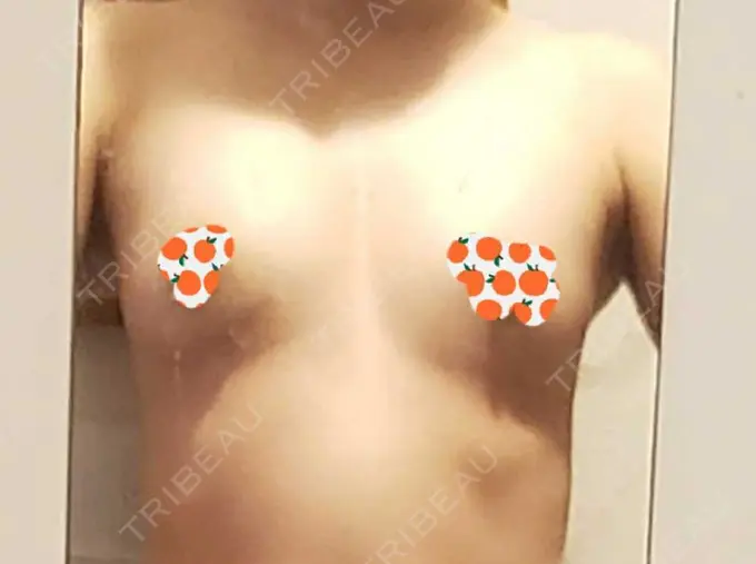 豊胸（脂肪注入） THE CLINIC（ザ・クリニック） 東京院 DAY 156 メイン用