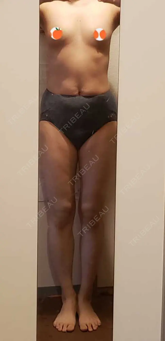 豊胸（脂肪注入） THE CLINIC（ザ・クリニック） 東京院 DAY 156 メイン用