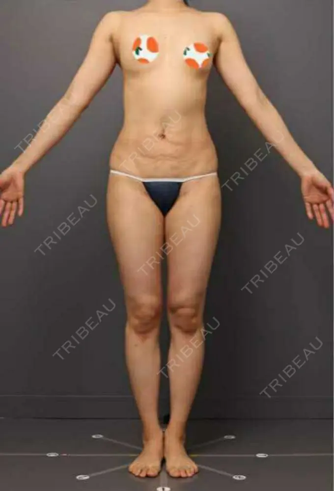 豊胸（脂肪注入） THE CLINIC（ザ・クリニック） 東京院 DAY 34 メイン用