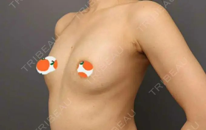 豊胸（脂肪注入） THE CLINIC（ザ・クリニック） 東京院 DAY 34 メイン用