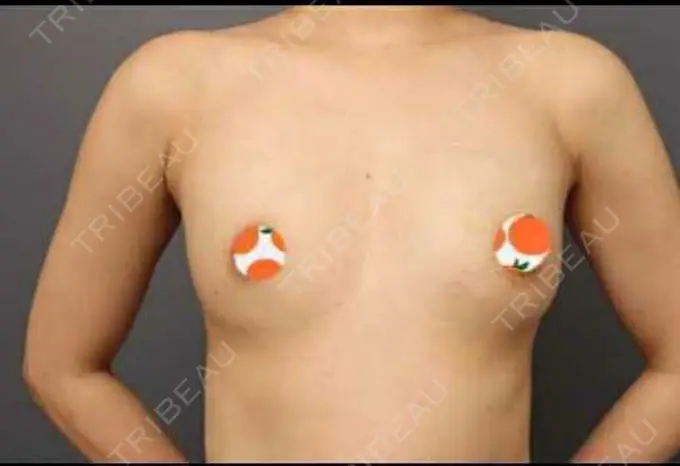 豊胸（脂肪注入） THE CLINIC（ザ・クリニック） 東京院 DAY 34 メイン用